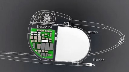 Marcapasos inalámbrico sin cirugía, aprobado por la FDA