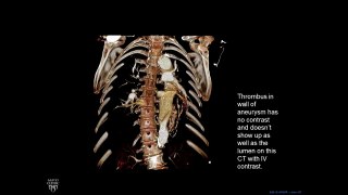 Plain Film Cardiac and Vascular Anatomy - Frontal Radiograph - Philip Araoz, M.D. - Part 7 of 10