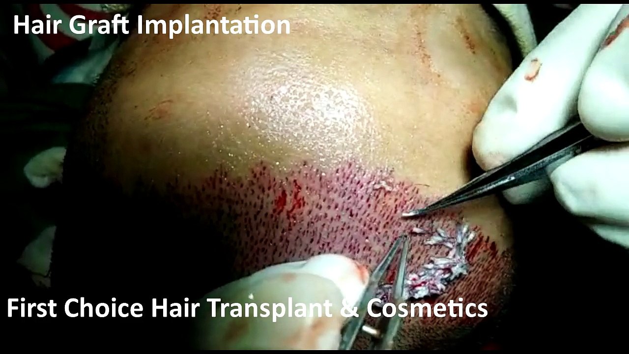 Live hair Graft Implantation during surgery at FCHTC Clinic in Ludhiana