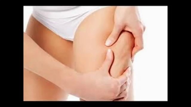 Como eliminar as estrias- dicas para ser mais bonita