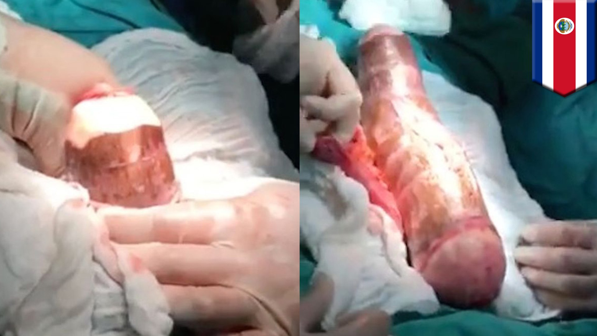 Giant improvised vegetable dildo stuck in man's anus removed after  hour-long surgery - video Dailymotion