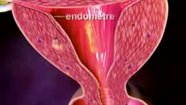 Une étudiante de 28 ans est décédée d'un cancer du col de l'utérus, diagnostiqué seulement 9 mois après son frottis