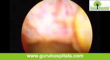 D Hysteroscopy Polypectomy - Infertility Treatments Tamilnadu