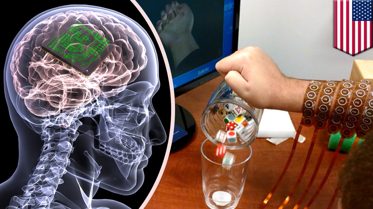 Paralyzed man regains hand function with chip implant