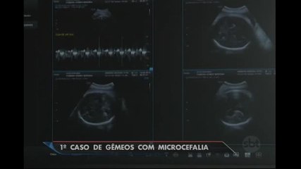 Paraíba registra 1º caso de gêmeos com microcefalia