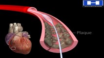 How Balloon Angioplasty is Done Animation - Coronary Angiography Procedure  Stenting in Heart Video