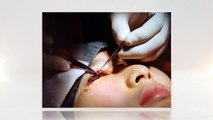 Upper Blespharosplasty (Eyelid lift) - Plastic Surgery