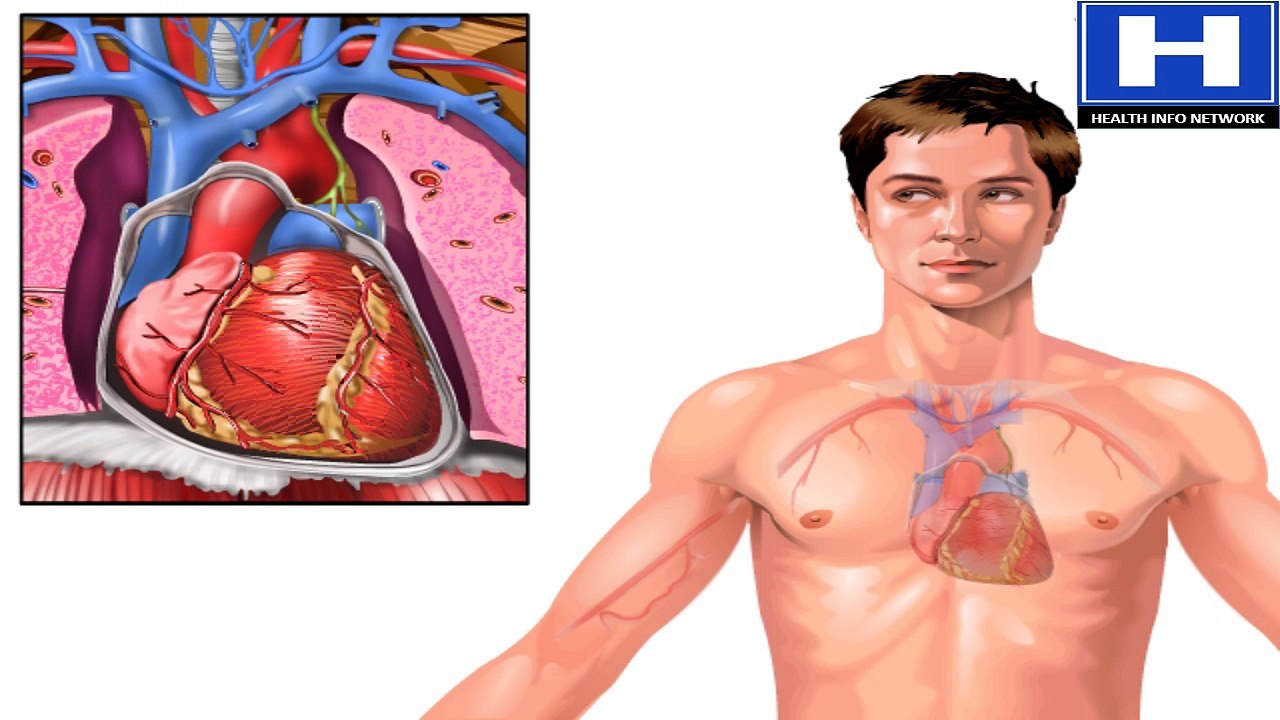 What is Coronary Artery Disease Pathophysiology of | CAD Animation - Heart Attack and Angina Video