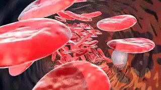 Kan kan sayısı damar  tıkanıklıgı damar ameleyatı Dekompresyon Hastalıgı Vurgun Blood