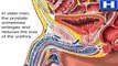 What is Prostate Enlargement Benign Prostatic Hyperplasia Animation -Symptoms of BPH Enlarged Video