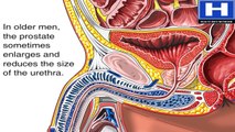 What is Prostate Enlargement Benign Prostatic Hyperplasia Animation -Symptoms of BPH Enlarged Video