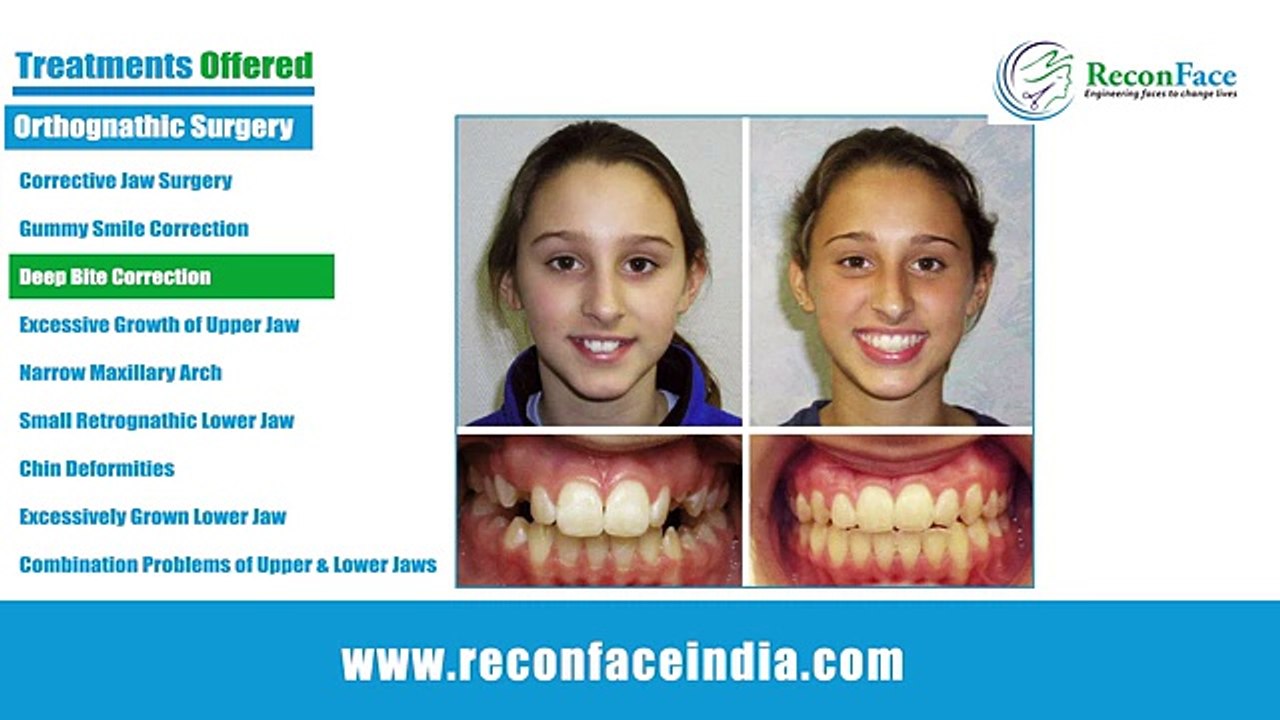 Cosmetic Surgery in Hyderabad | Chin Augmentation India