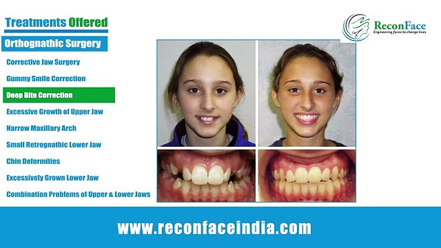 Cosmetic Surgery in Hyderabad | Chin Augmentation India