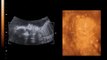 Caitlyn 25 wks old - 4D Ultrasound