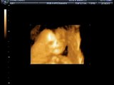 lucas 07/12/08 ultrasound 22 weeks (semanas)