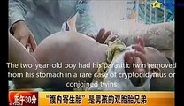 Pregnant 2 year-old boy gives BIRTH to parasitic twin