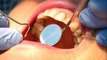 Dental Health | Dental Health & Wellness | Tooth Filling Without Drilling | Teeth Feeling In Urdu Video