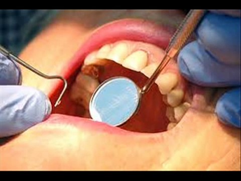 Dental Health | Dental Health & Wellness | Tooth Filling Without Drilling | Teeth Feeling In Urdu Video