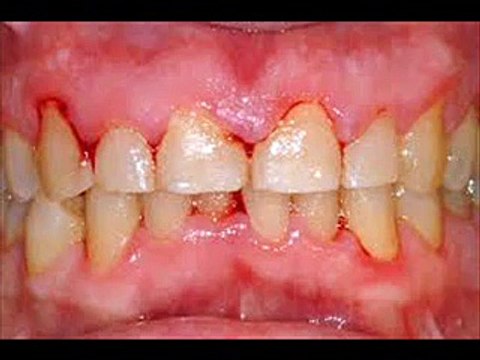 DENTAL CARE 3 | Tooth Color INFECTION CONTROL HEALTH EDUCATION ICSP 94 URDU ⁄ HINDI URDU VIDEO