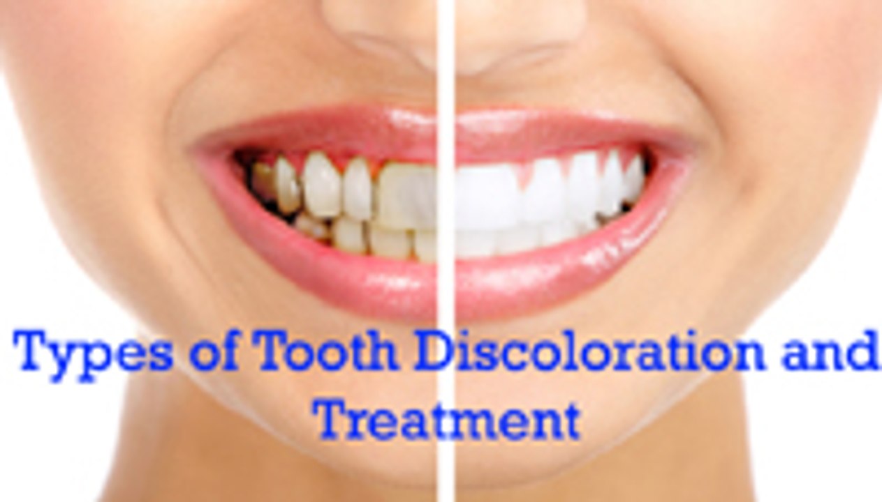 Dental Health | Dental Health & Wellness | Dental Fluorosis Or Discoloured Teeth