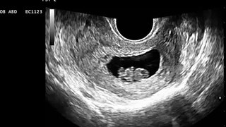 2d sonogram 8wk 4day old fetus.avi