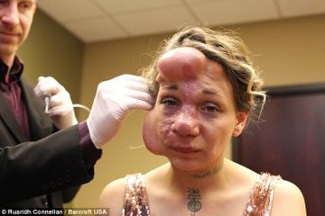 Atardamarlarındaki Bozukluk Genç Kadının Hayatını Kararttı