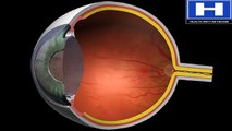 How glaucoma damages optic nerve - How glaucoma causes blindness - Glaucoma causes and complications
