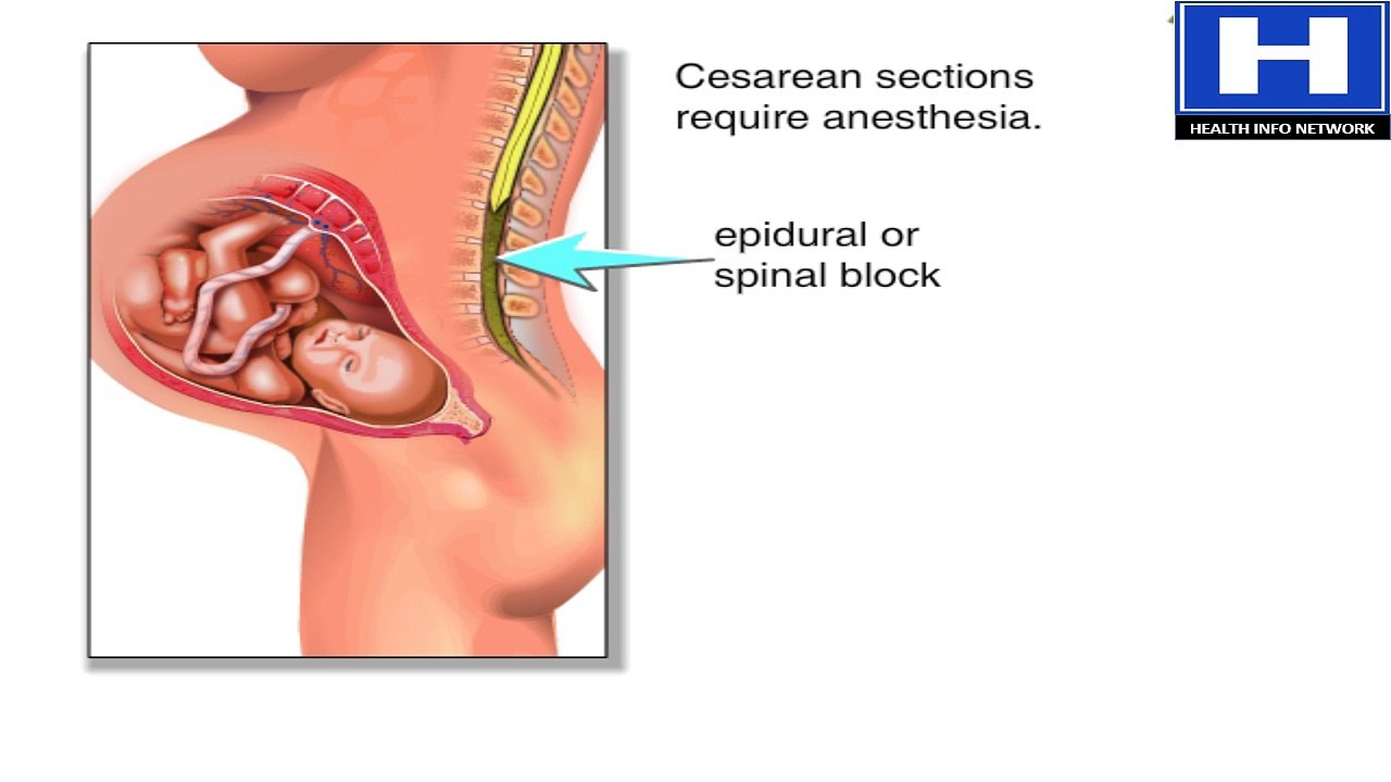 What is cesarean(C- section) - How C-section performed - Advantages and disadvantages of C-section