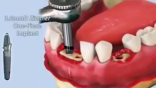 Wow Amazing Teeth transplant