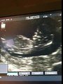 Ultrasound scan of our first baby at 12 weeks