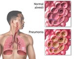 Asthma Attack Treatment, Pathophysiology and Symptoms