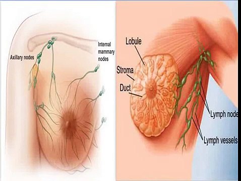 Breast Cancer symptoms, Diagnosis, Treatment, Prognosis - Complete Documentary
