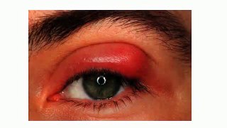 Hordeolum, Chalazion and Stye Removal from Eyelid Naturally at home