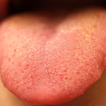 How to get rid of ulcers in mouth, stomach, throat, tongue and leg ulcers