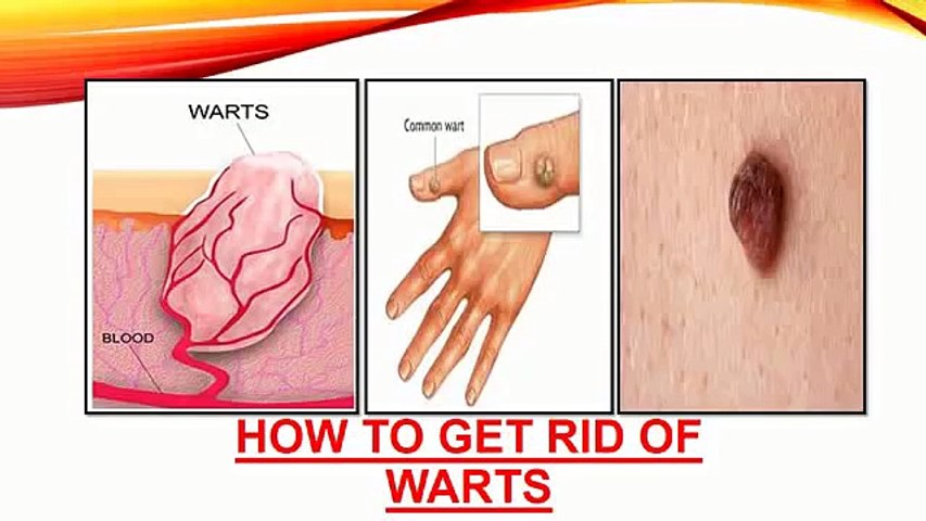 How to get rid of warts on face, neck, fingers and hands