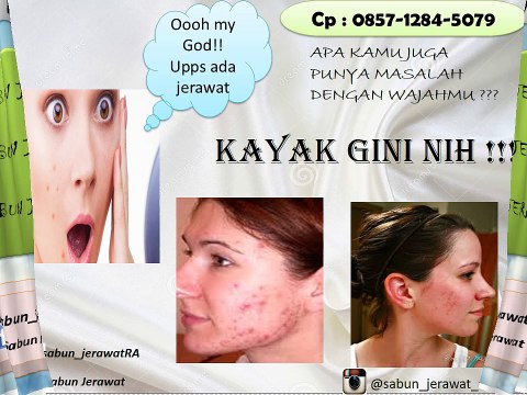 085 712 845 079, obat pembersih jerawat, obat jerawat muka,obat penghilang jerawat dan bekas jerawat alami RA