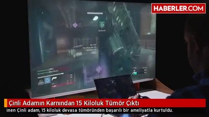 Çinli Adamın Karnından 15 Kiloluk Tümör Çıktı