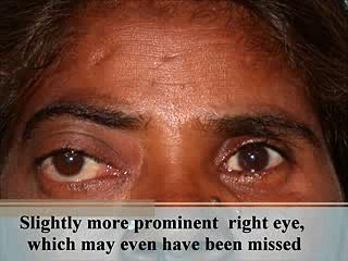 Proptosis Surgery | Big Eyes | Cavernous Hemangioma | Orbital Lymphoma | Oculoplastic Surgery India