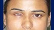 Prosthetic Eye Post Enucleation Evisceration Eye Surgery in India - Dr. Debraj Shome