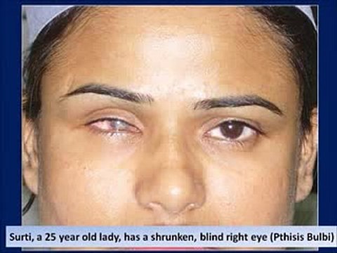 Prosthetic Eye Post Enucleation Evisceration Eye Surgery in India - Dr. Debraj Shome