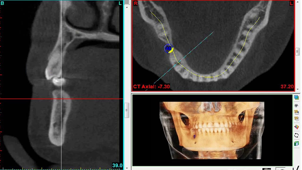 Dental Implant, Bone Graft & Sinus Lifts |Oasis Dental|Specialist Team|Milton,Oakville,Mississauga