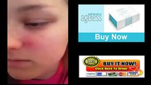 No More #Acne, No More #Zit OMG #InstantlyAgeless Takes Out #Teen's #Pimples In Minutes