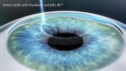 The Femto-Lasik makes LASIK even safer and more accurate