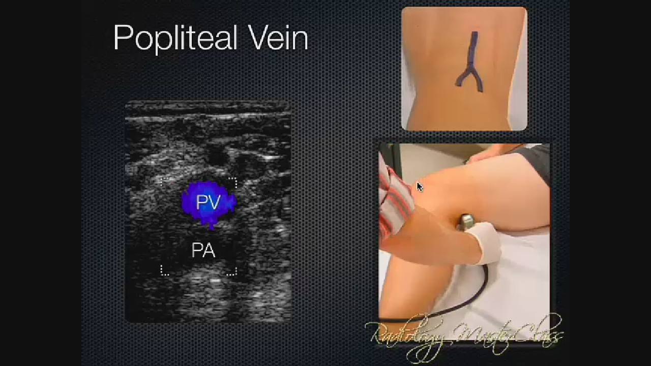 4- Abdominal Aorta, Vena Cava, and Deep venous thrombosis Ultrasound