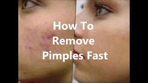 How To Remove Pimples Fast - Acne no more - The secrets curing your Acne