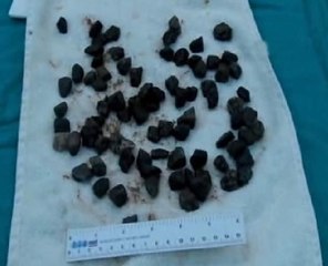 Midesinden yarım kilo taş çıktı