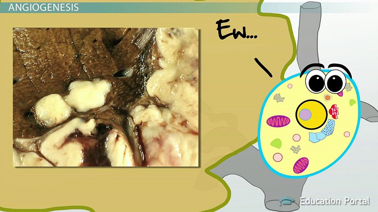 Metastasis: How Cancer Spreads