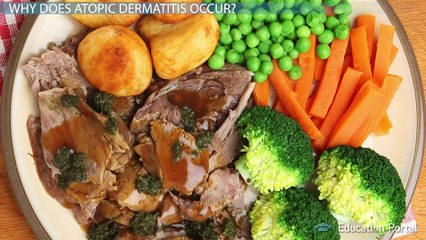 Atopic Dermatitis: Skin Allergies