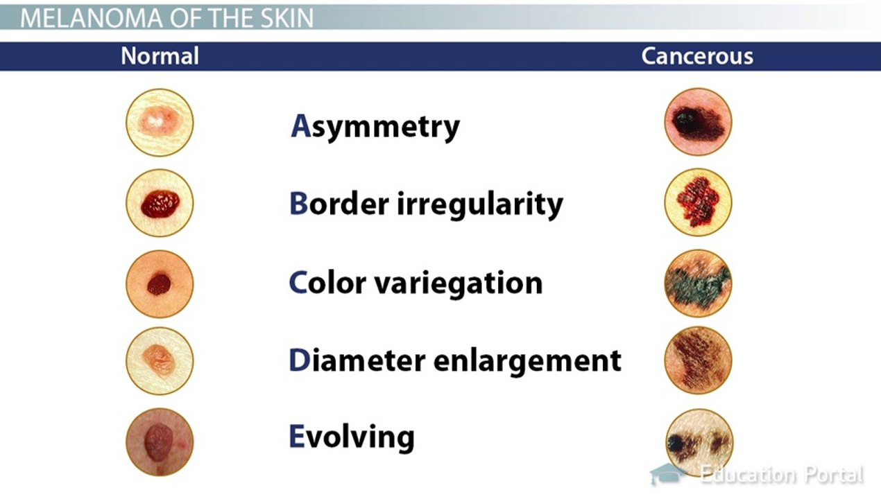 Melanoma