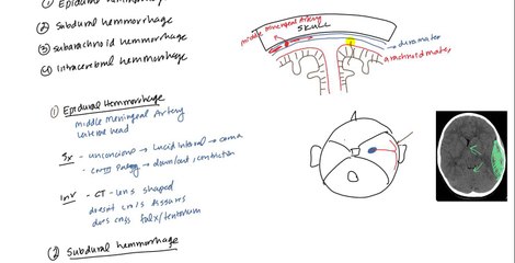 Epidural Haematoma in Emergency Medicine